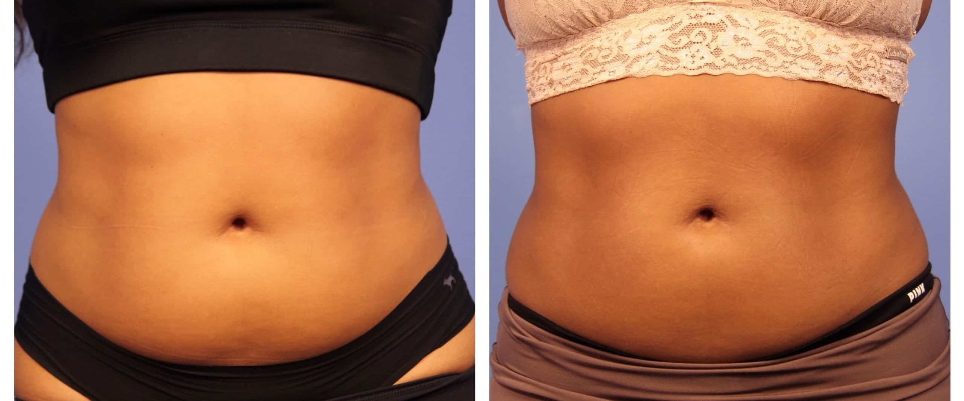 how-long-do-the-results-of-coolsculpting-last