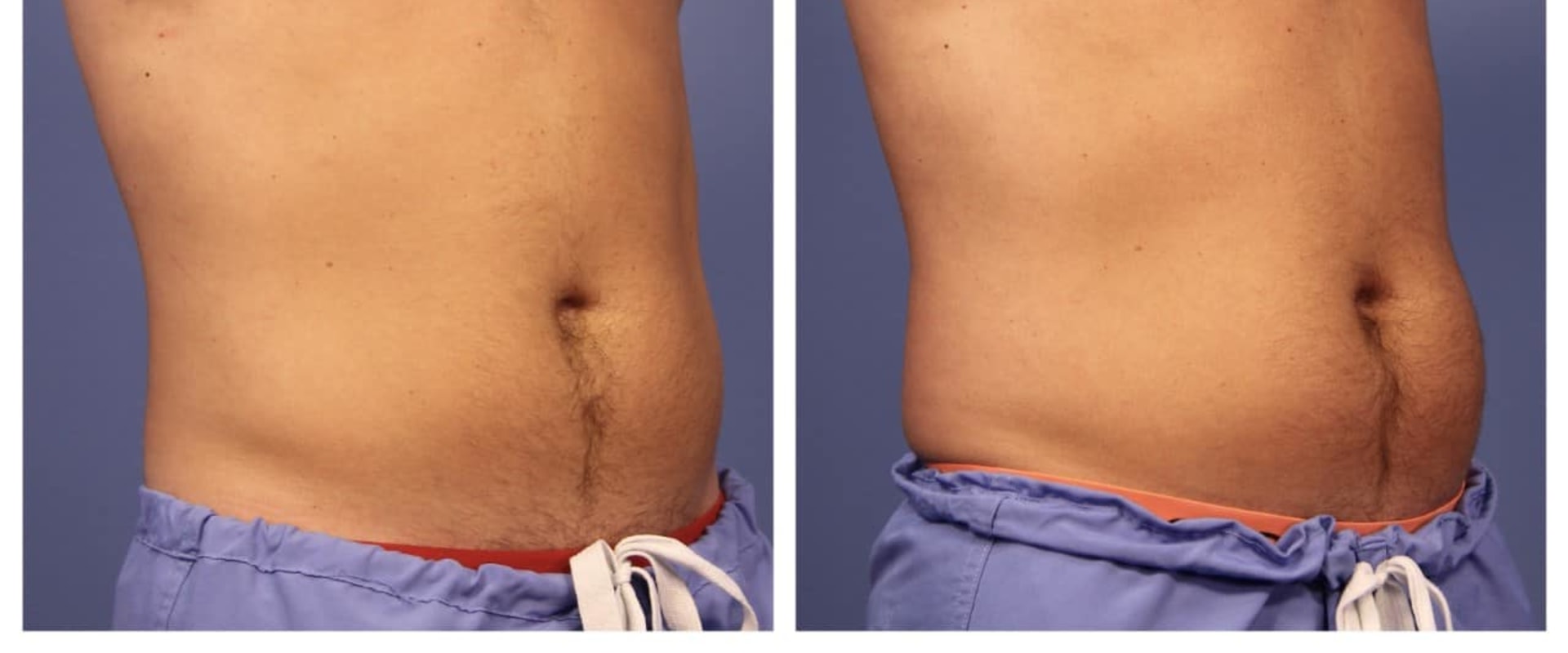 Does coolsculpting work on lower stomach?