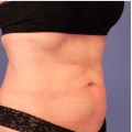 How many coolsculpting treatments are needed for stomach?