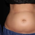 Does coolsculpting damage the skin?