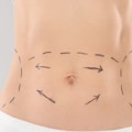 What are the long term effects of coolsculpting?