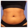 How effective is coolsculpting for belly?