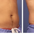 Does coolsculpting work on lower stomach?