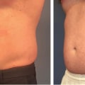 Is coolsculpting the same everywhere?