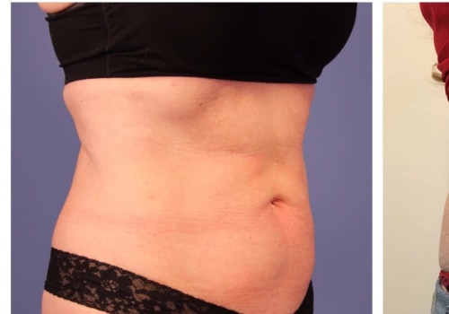 How many coolsculpting treatments are needed for stomach?