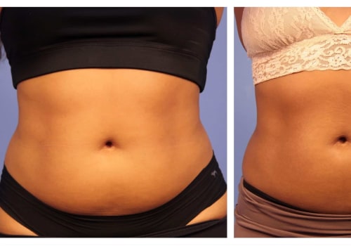 How fast are coolsculpting results?