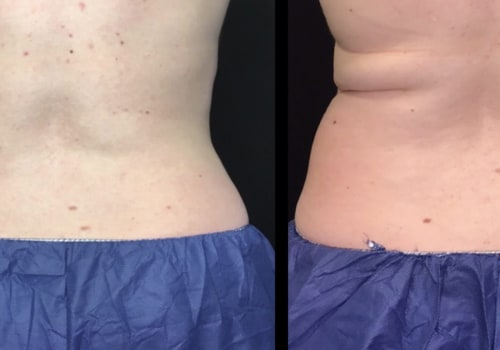 How fast does fat come back after coolsculpting?