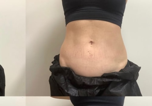 Can you see coolsculpting results after 2 weeks?