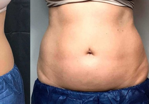 How many times does it take for coolsculpting to work?