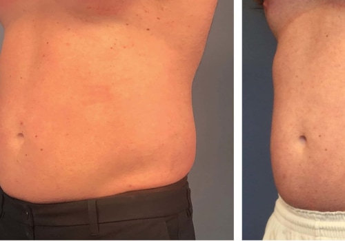 Is coolsculpting the same everywhere?